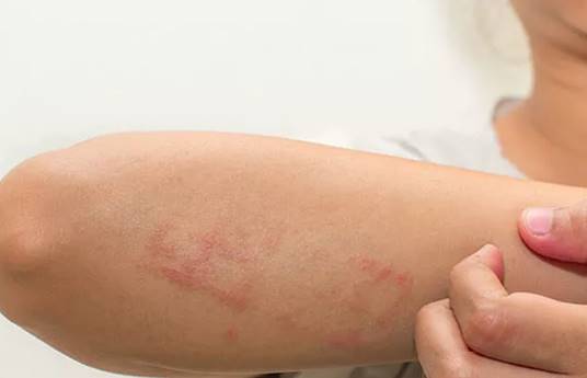 Jenis Penyakit Kulit Yang Paling Umum Menyerang Tubuh Dermatitis Atopik