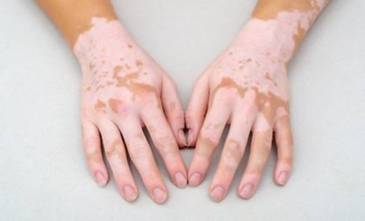 Jenis Penyakit Kulit Yang Paling Umum Menyerang Tubuh Vitiligo