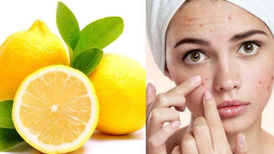 Cara Menghilangkan Bekas Jerawat Hitam Di Pipi Lemon